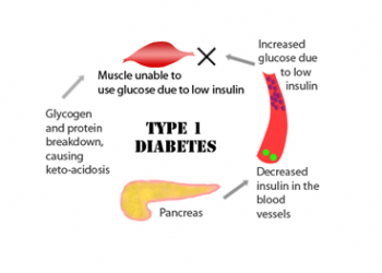 Type 1 Diabetes