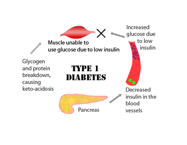 Type 1 Diabetes