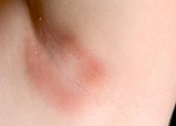 CANDIDIASIS