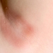 CANDIDIASIS