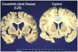 Creutzfeldt-Jakob Disease