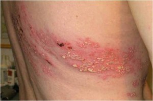 Herpes Zoster
