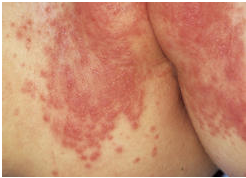 Jacquest Erythema