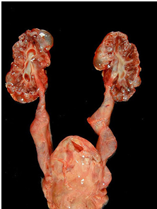 Kidney Dysplasia