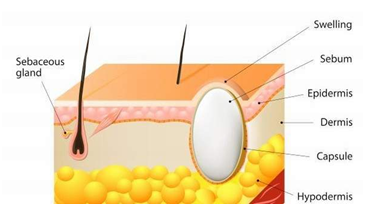 Sebaceous Cyst