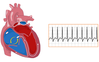 Tachycardia