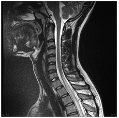 Transverse Myelitis