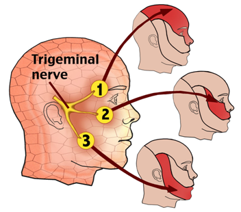 Trigeminal Neuralgia