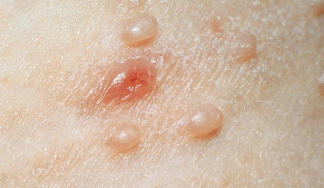 MOLLUSCUM CONTAGIOSUM