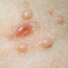 MOLLUSCUM CONTAGIOSUM