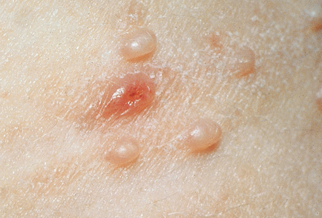 MOLLUSCUM CONTAGIOSUM