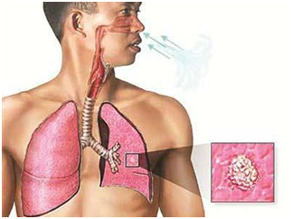 Multidrug Resistant TB