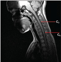 Neuromyelitis Optica