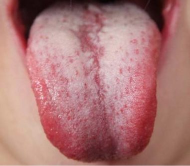 Oral Thrush Causes, Symptoms, Diagnosis and Treatment 