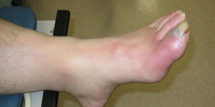 Osteomyelitis