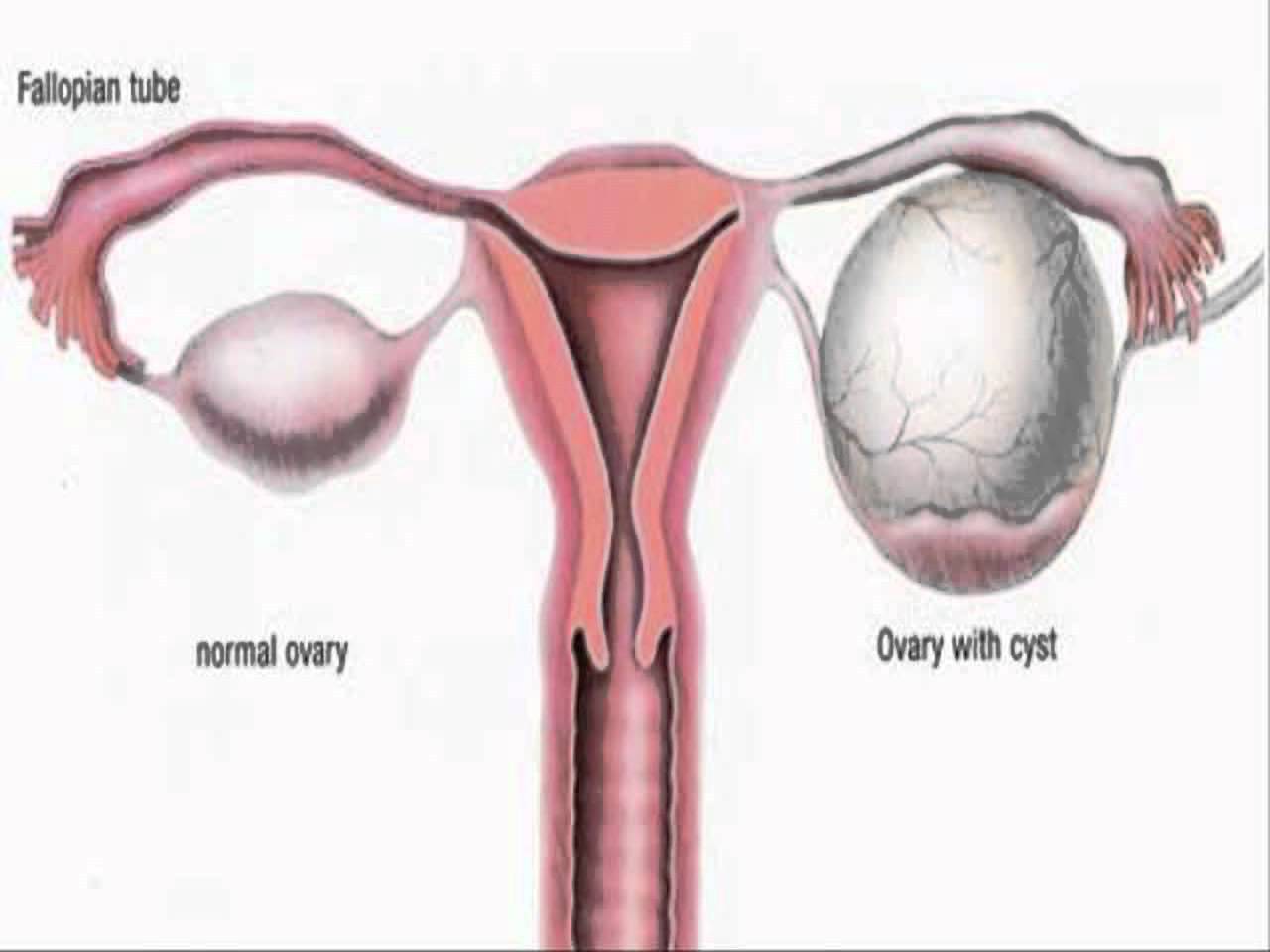 Ovarian Cyst