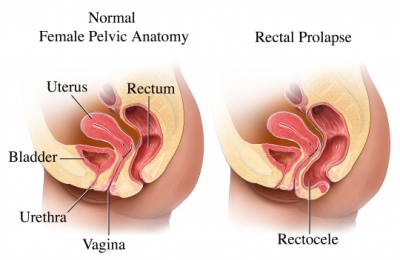 RECTAL PROLAPSE