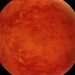 Retinal Vein Occlusion