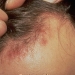 Seborrheic Dermatitis