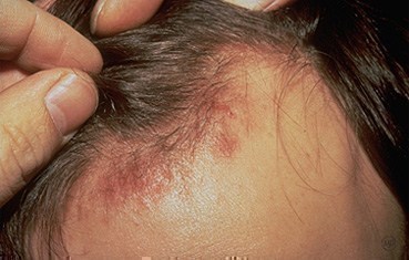 Seborrheic Dermatitis