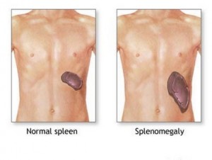 Splenomegaly