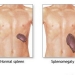 Splenomegaly