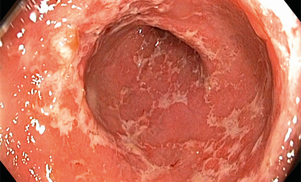 Ulcerative Colitis