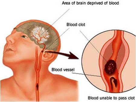 Vascular dementia