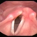 Vocal cord paralysis