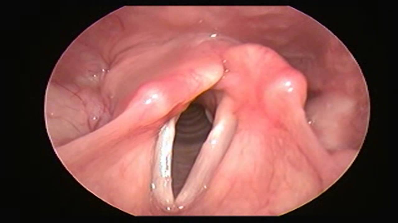 Vocal cord paralysis