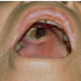 Zygomycosis