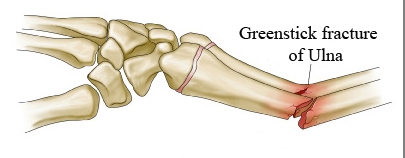 Greenstick fractures Causes, Symptoms, Diagnosis and Treatment