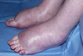 Oedema