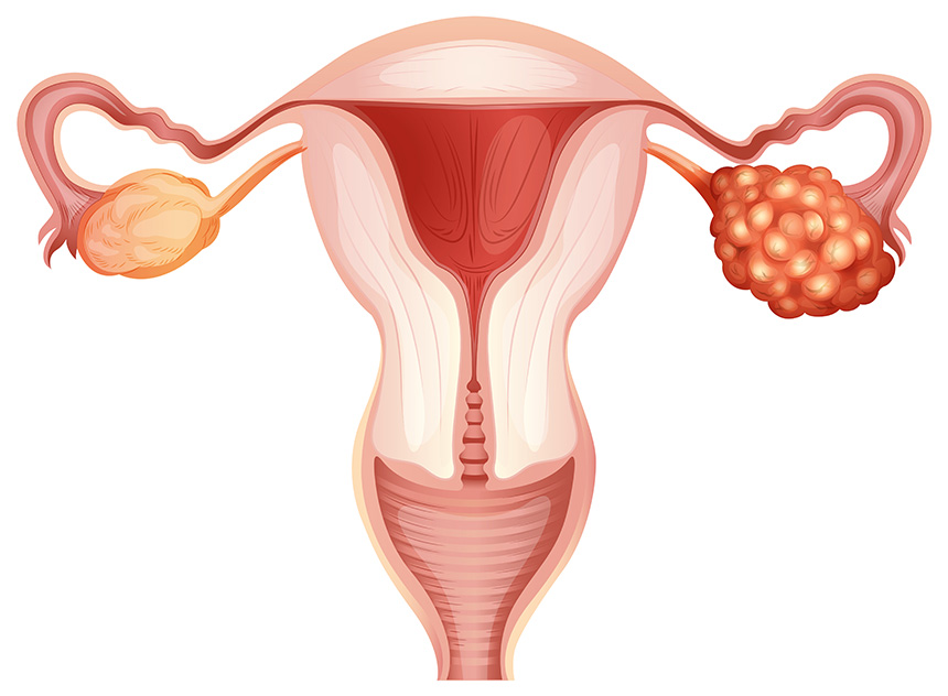 Ovarian Cancer Causes, Symptoms, Diagnosis and Treatment ...