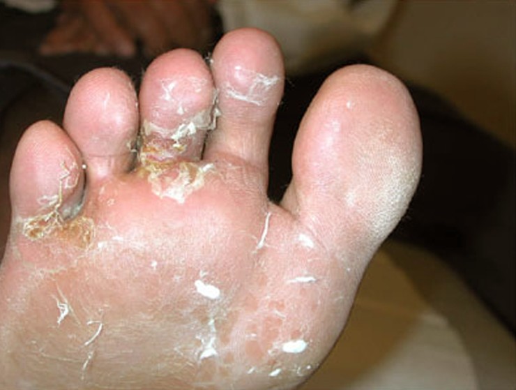 TINEA PEDIS