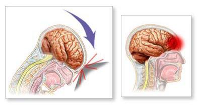 Traumatic Brain Injury