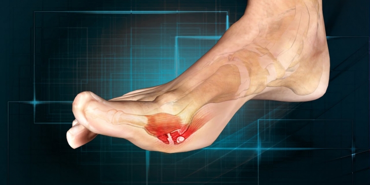 Turf Toe