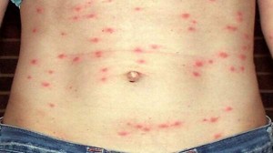 Typhus