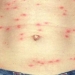Typhus