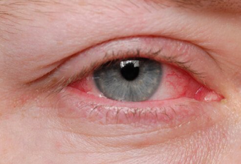 FUNGAL EYE INFECTION