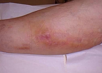 Thrombophlebitis
