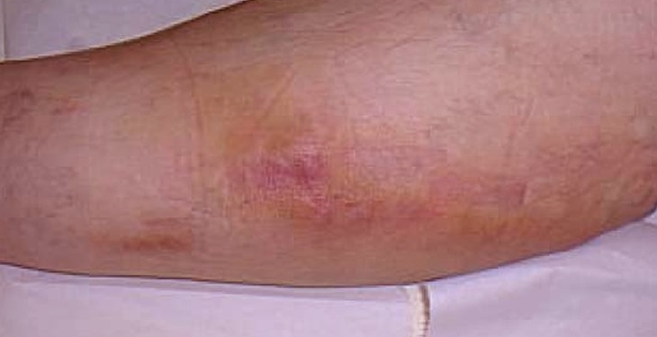 Thrombophlebitis Causes, Symptoms, Diagnosis and Treatment | Natural ...