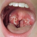 Tonsillitis