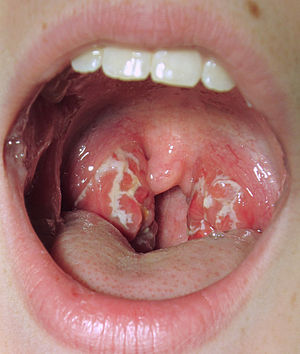 Tonsillitis