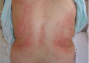 THROMBOCYTOPENIA