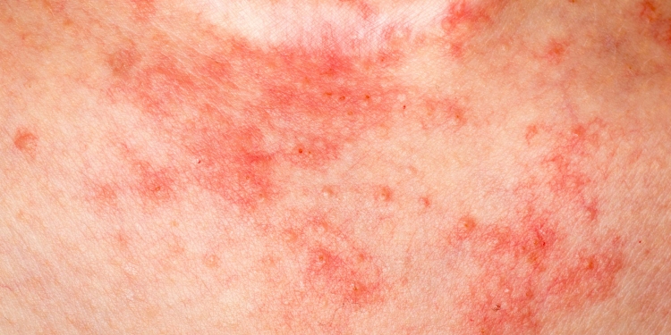 Eczema Causes, Symptoms, Diagnosis and Treatment