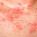 Eczema Causes, Symptoms, Diagnosis and Treatment