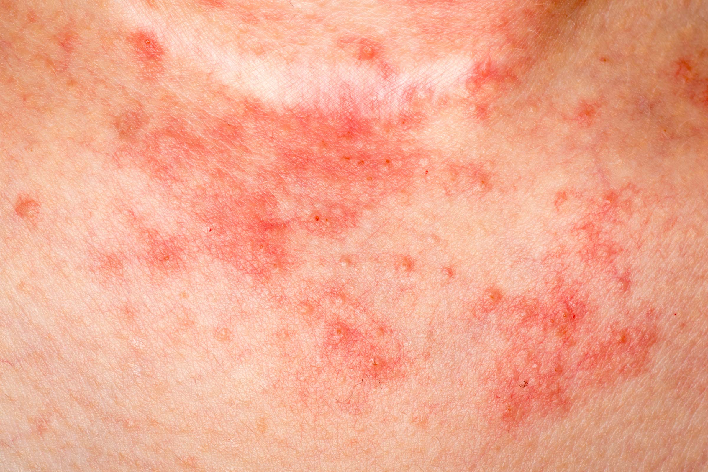 Eczema Causes, Symptoms, Diagnosis and Treatment