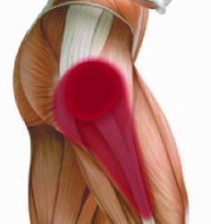 TROCHANTERIC BURSITIS