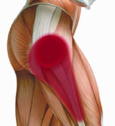 TROCHANTERIC BURSITIS